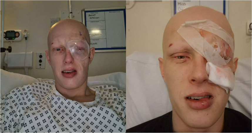 英國米德斯堡庫爾比紐漢（Coulby Newham）一名25歲男子康納（Connor McKenna-West）日前放煙火時，遭到煙火炸臉，導致他右眼被炸碎。（圖／Facebook／Connor McKenna-West）